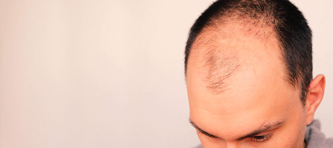Alopecia androgenética (calvície)