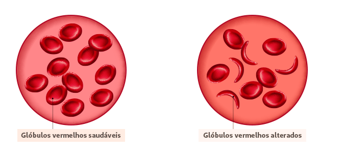 Imagem ilustrativa de glóbulos vermelhos da anemia falciforme